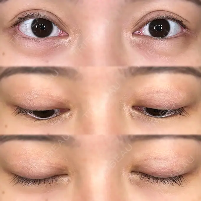 二重切開 / 目頭切開 / クマ治療 / 目尻切開 / 上まぶたたるみ取り / 下まぶたの脂肪取り / 脂肪注入（目の下） 湘南美容クリニック 大阪堺東院 DAY 221 メイン用