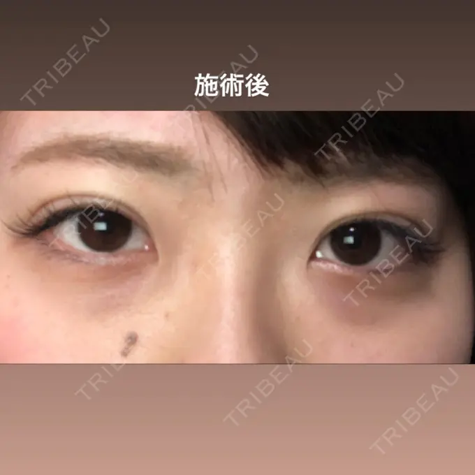 二重埋没 湘南美容クリニック 長野院 DAY 0 メイン用