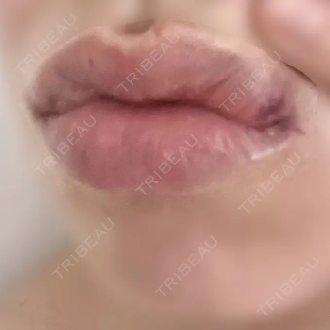 ヒアルロン酸注入（唇） ルラ美容クリニック 名古屋栄院 / ルラスキンクリニック 名古屋栄院 DAY 3 メイン用