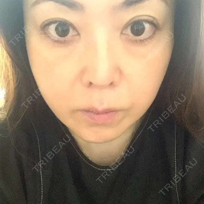 糸リフト / ヒアルロン酸注入（頬） ネビュラクリニック 京都院 DAY 10 メイン用