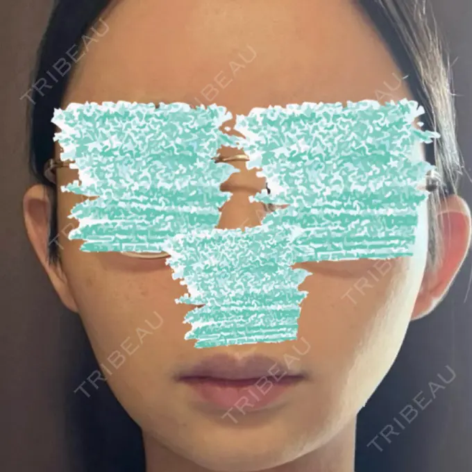 骨切り（あご） / 骨削り（エラ） リラ・クラニオフェイシャル・クリニック 大阪院 AFTER メイン用