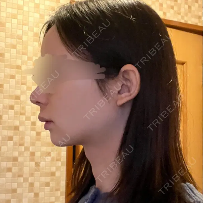 骨切り（あご） / 骨削り（エラ） リラ・クラニオフェイシャル・クリニック 大阪院 DAY 1297 メイン用