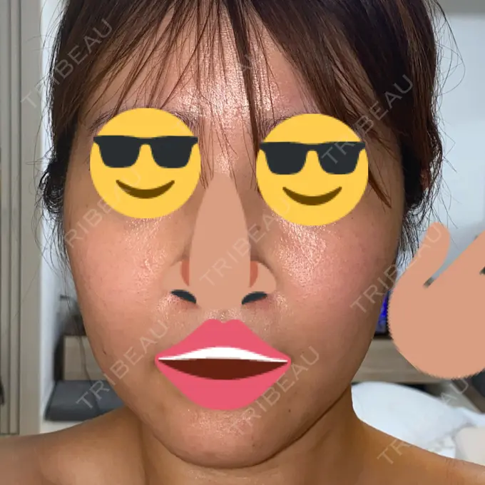 その他（肌） / エレクトロポレーション / RF（高周波）たるみ治療 / ポテンツァ ゆきスキンクリニック 東池袋 AFTER メイン用