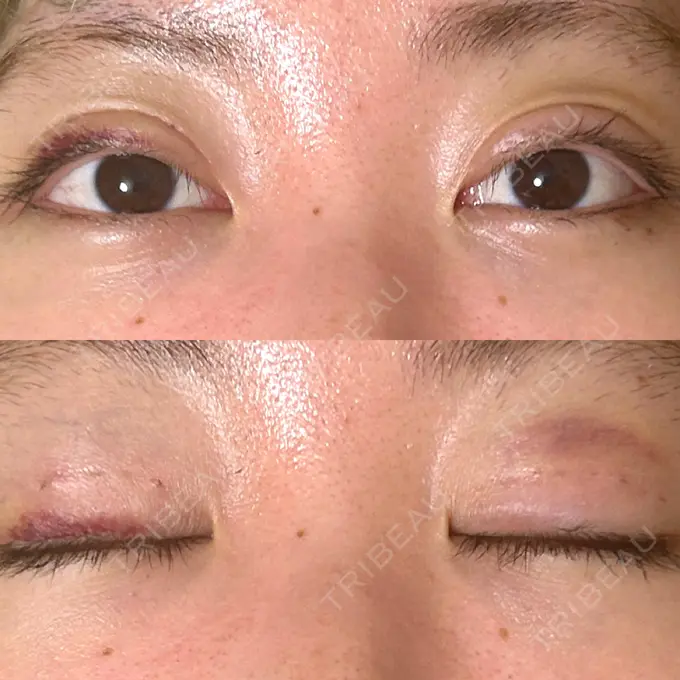 二重埋没 東京ココセランクリニック DAY 11 メイン用