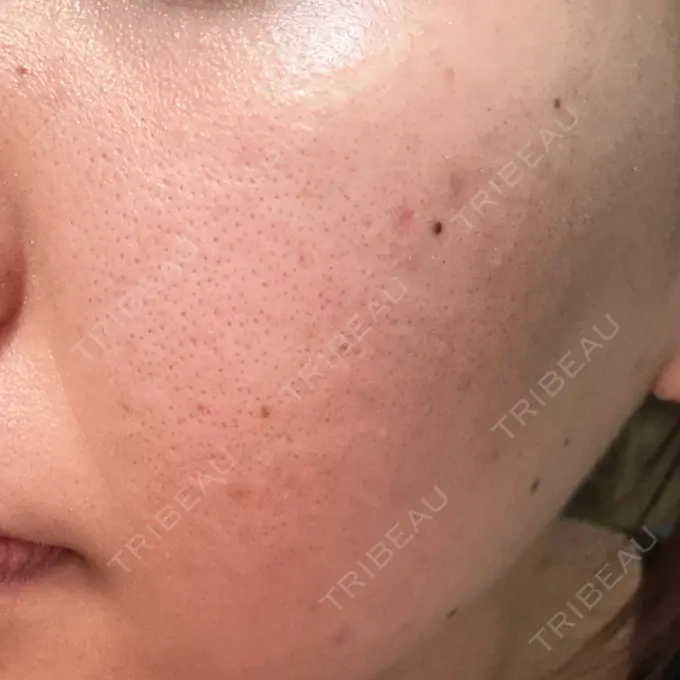 美肌レーザー / シミ取りレーザー / フラクショナルレーザー（毛穴・ニキビ跡） / YAGレーザー / 赤み除去レーザー / ピコフラクショナルレーザー（毛穴・ニキビ跡） AI Beauty Clinic （エーアイ美容クリニック） DAY 5 メイン用