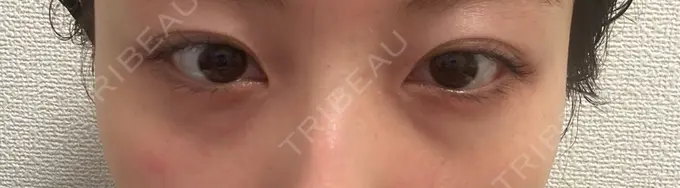 クマ治療 ROOTS Clinic DAY 7 メイン用