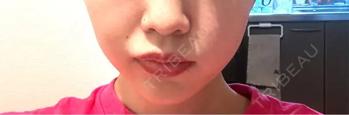 ヒアルロン酸注入（涙袋） / ヒアルロン酸注入（あご） / ボトックス（エラ・小顔） RIVER CLINIC（リバークリニック） AFTER メイン用