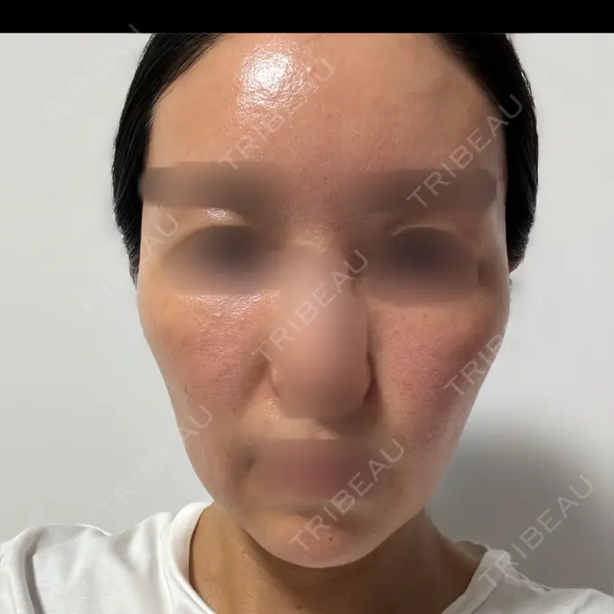 ピーリング（ニキビ・毛穴） / LED治療 東京素肌クリニック 銀座本院 DAY 0 メイン用