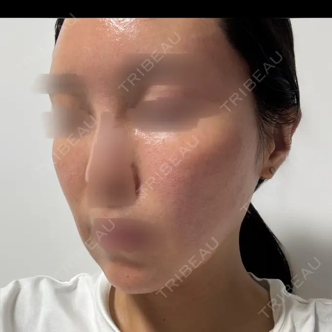 ピーリング（ニキビ・毛穴） / LED治療 東京素肌クリニック 銀座本院 DAY 0 メイン用