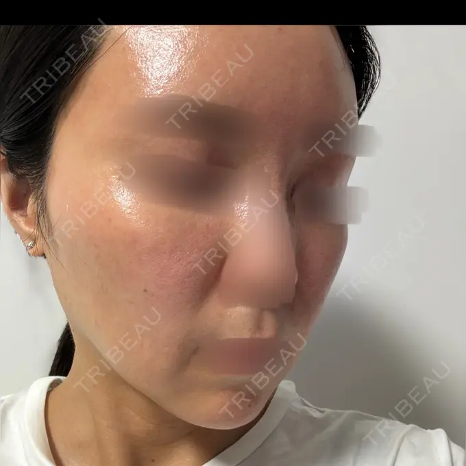 ピーリング（ニキビ・毛穴） / LED治療 東京素肌クリニック 銀座本院 DAY 0 メイン用