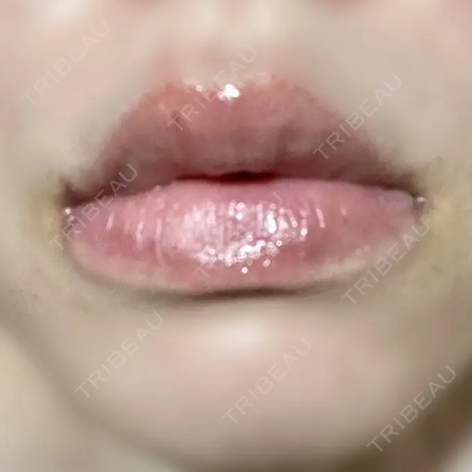 ヒアルロン酸注入（唇） ルラ美容クリニック 名古屋栄院 / ルラスキンクリニック 名古屋栄院 DAY 4 メイン用