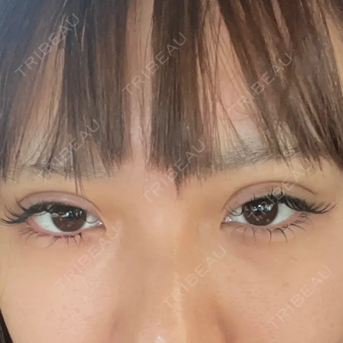 二重埋没 日本ウェルネス再生クリニック DAY 0 メイン用