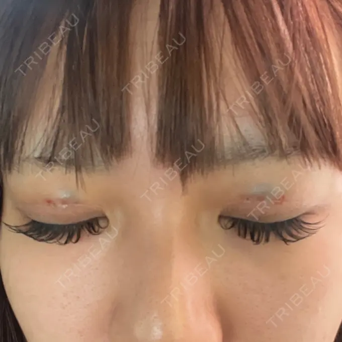 二重埋没 日本ウェルネス再生クリニック DAY 0 メイン用