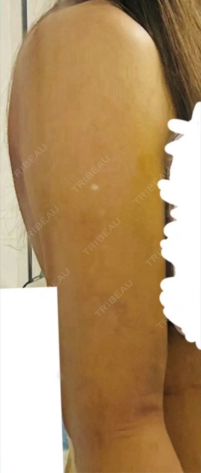 脂肪吸引（二の腕） / 脂肪吸引（肩） / その他（ボディ） ルーチェクリニック 銀座院 DAY 5 メイン用