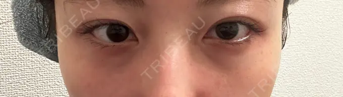 クマ治療 ROOTS Clinic DAY 8 メイン用