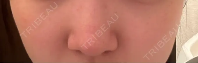 ピコスポット 美容皮膚科エルムクリニック 麻布院 DAY 17 メイン用