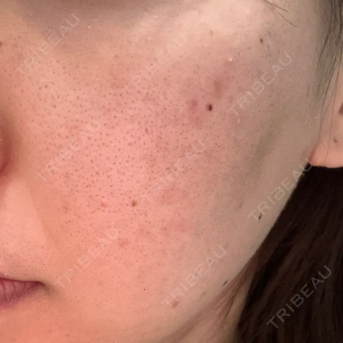 美肌レーザー / シミ取りレーザー / フラクショナルレーザー（毛穴・ニキビ跡） / YAGレーザー / 赤み除去レーザー / ピコフラクショナルレーザー（毛穴・ニキビ跡） AI Beauty Clinic （エーアイ美容クリニック） AFTER メイン用