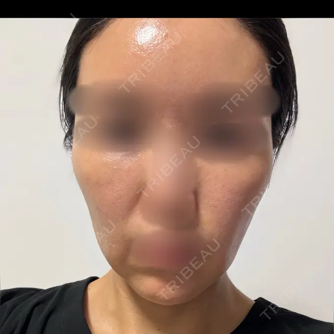 ピーリング（ニキビ・毛穴） / LED治療 東京素肌クリニック 銀座本院 AFTER メイン用