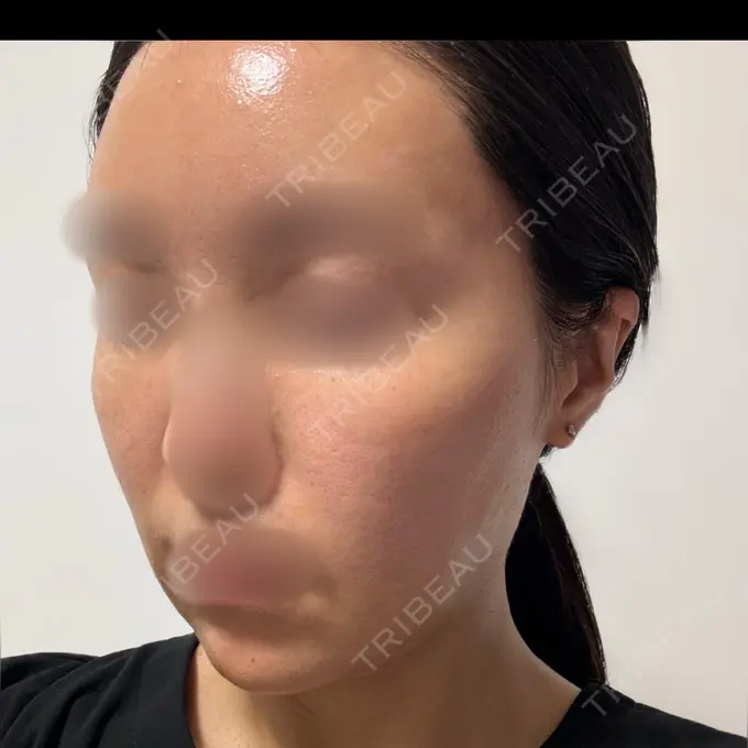 ピーリング（ニキビ・毛穴） / LED治療 東京素肌クリニック 銀座本院 DAY 1 メイン用