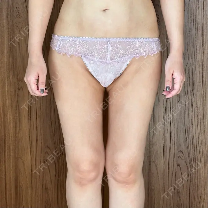 脂肪吸引（顔） / 脂肪吸引（脚） / 脂肪吸引（お尻） Mods Clinic（モッズクリニック） 福岡院 AFTER メイン用