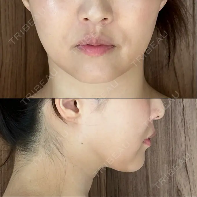 脂肪吸引（顔） / 脂肪吸引（脚） / 脂肪吸引（お尻） Mods Clinic（モッズクリニック） 福岡院 DAY 168 メイン用