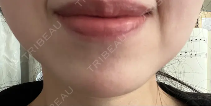 ボトックス（あご） ルラ美容クリニック 名古屋本院 DAY 3 メイン用