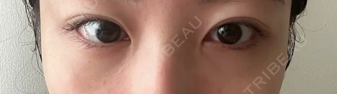 クマ治療 ROOTS Clinic DAY 9 メイン用