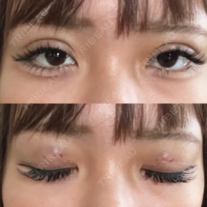 二重埋没 日本ウェルネス再生クリニック DAY 1 メイン用