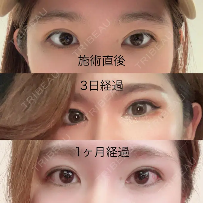 二重埋没 ネビュラクリニック 広島院 AFTER メイン用