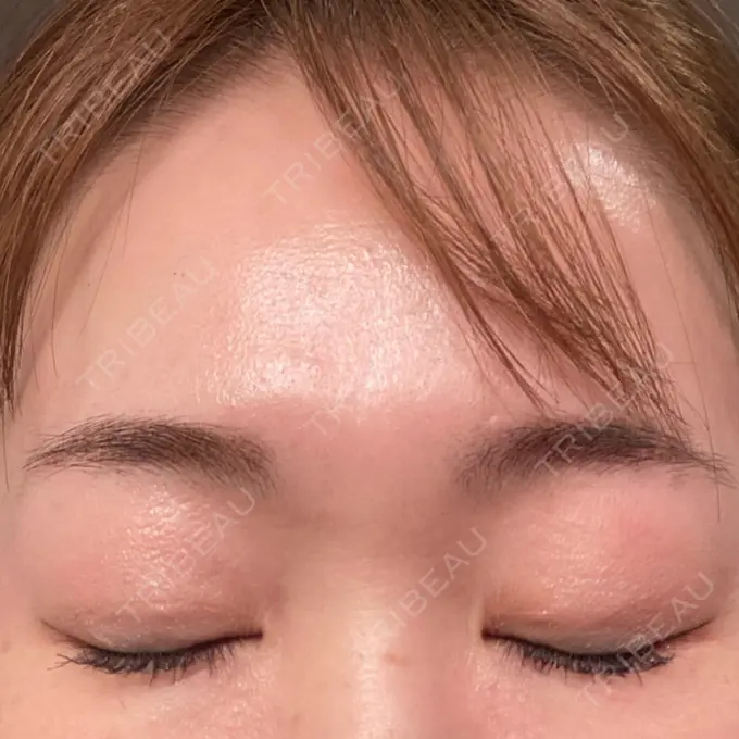 アートメイク（眉） Tokyo Tensei Clinic 新宿院 DAY 6 メイン用