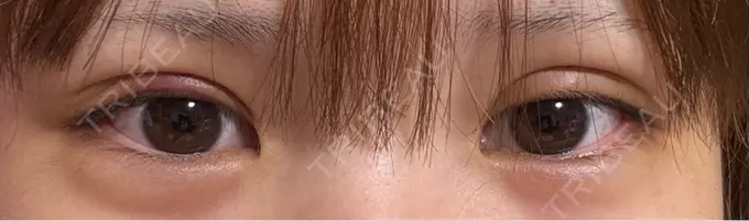 二重埋没 / 上まぶたの脂肪取り THE FIRST CLINIC 多摩センター院 DAY 2 メイン用