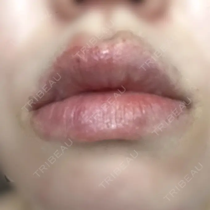 ヒアルロン酸注入（唇） ルラ美容クリニック 名古屋栄院 / ルラスキンクリニック 名古屋栄院 DAY 6 メイン用