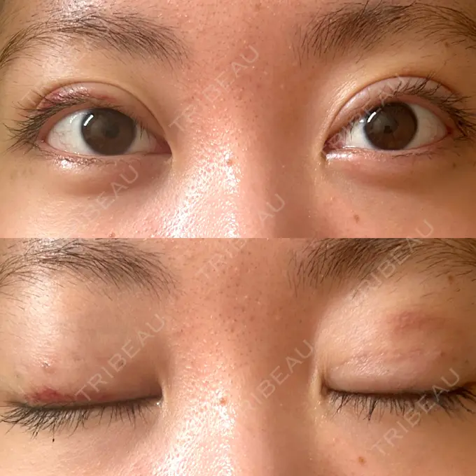 二重埋没 東京ココセランクリニック DAY 14 メイン用