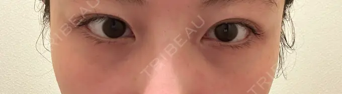 クマ治療 ROOTS Clinic DAY 10 メイン用