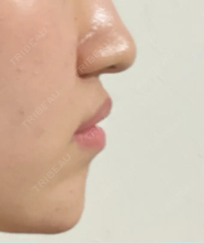 ボトックス（あご） / ボトックス（エラ・小顔） / ボトックス（口角） / ボトックス（人中） / ピーリング（ハリ・ツヤ） 湘南美容クリニック 金山院 AFTER メイン用