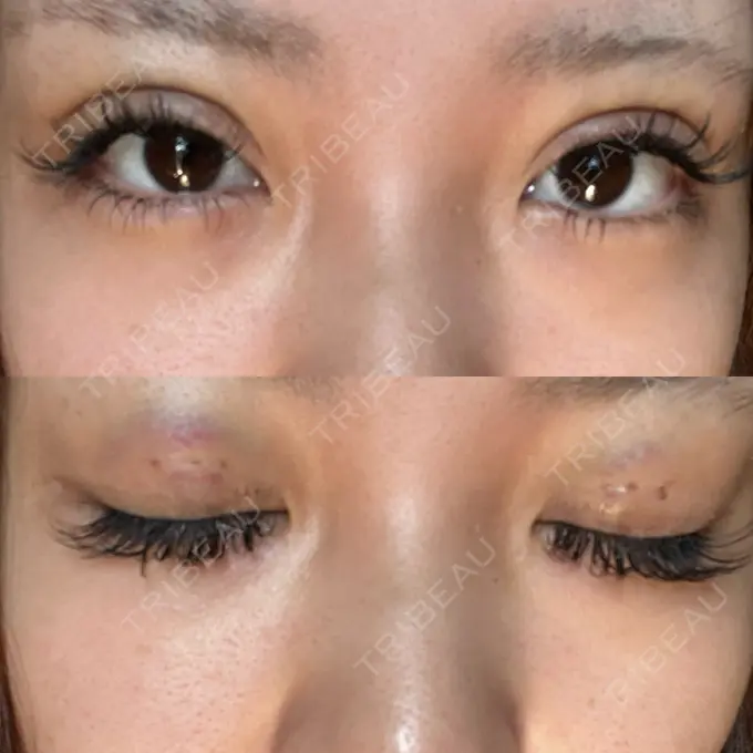 二重埋没 日本ウェルネス再生クリニック DAY 2 メイン用