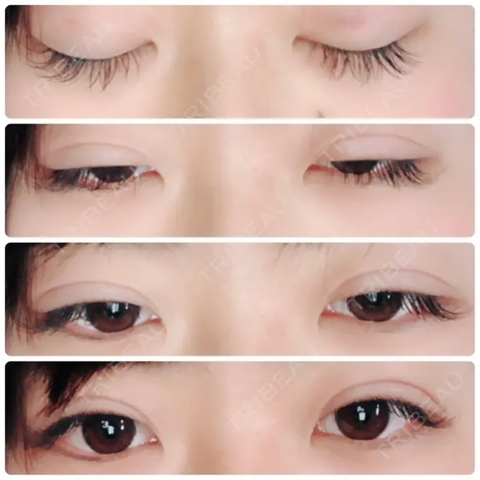 二重埋没 湘南美容クリニック 長野院 DAY 1 メイン用