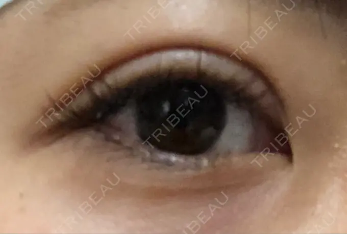 二重埋没 湘南美容クリニック 長野院 DAY 1 メイン用