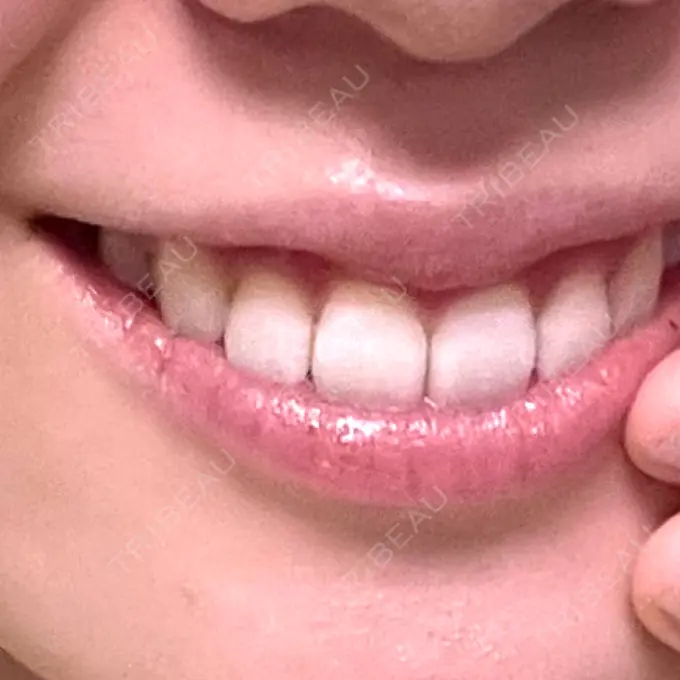 ホワイトニング 銀座青山You矯正歯科 渋谷院 DAY 1 メイン用