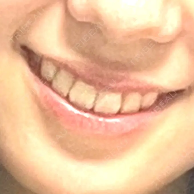 ホワイトニング 銀座青山You矯正歯科 渋谷院 DAY 1 メイン用