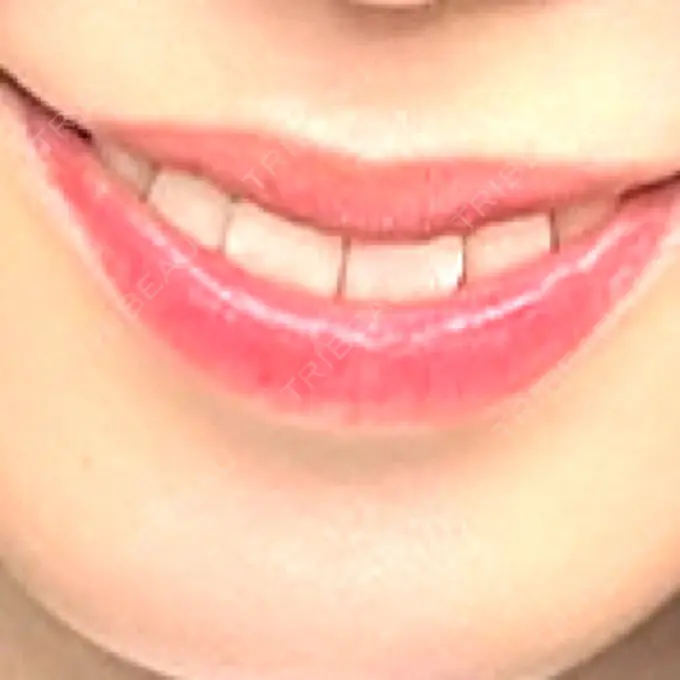 ホワイトニング 銀座青山You矯正歯科 渋谷院 DAY 1 メイン用