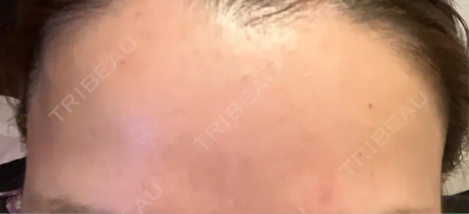 ボトックス（額） TCB東京中央美容外科 横浜駅前院 DAY 0 メイン用