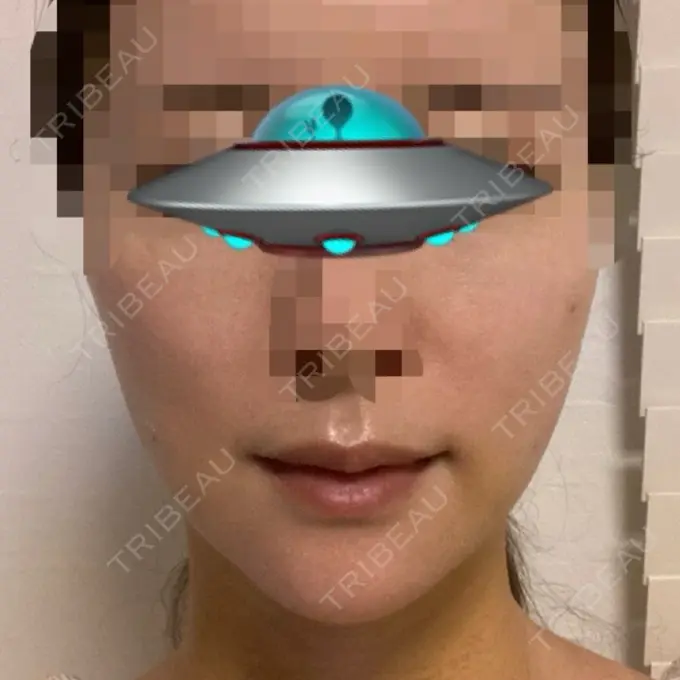 糸リフト / 骨切り（あご） / 脂肪吸引注射（顔） 銀座マイアミ美容外科 DAY 4 メイン用