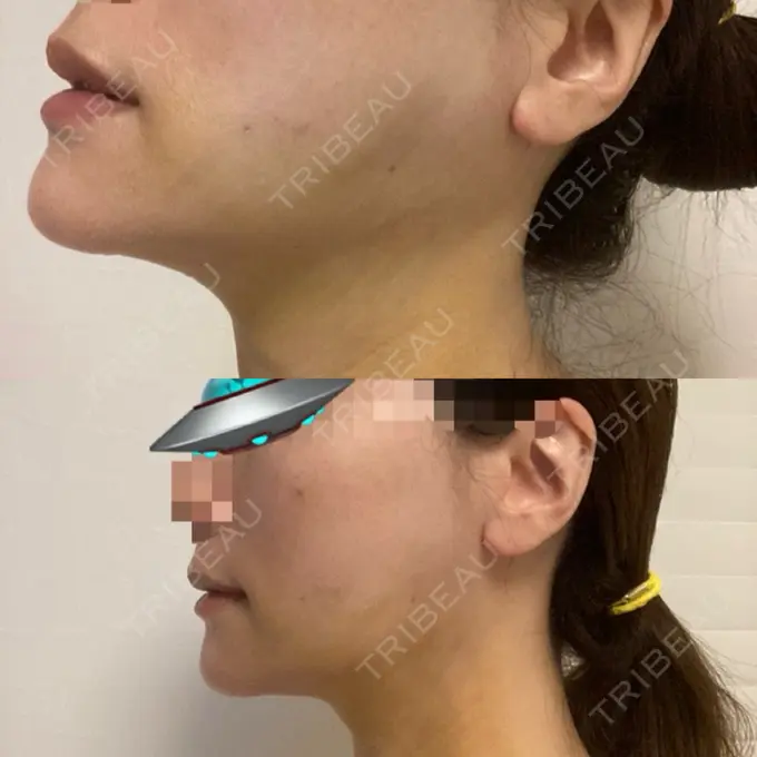 糸リフト / 骨切り（あご） / 脂肪吸引注射（顔） 銀座マイアミ美容外科 DAY 4 メイン用