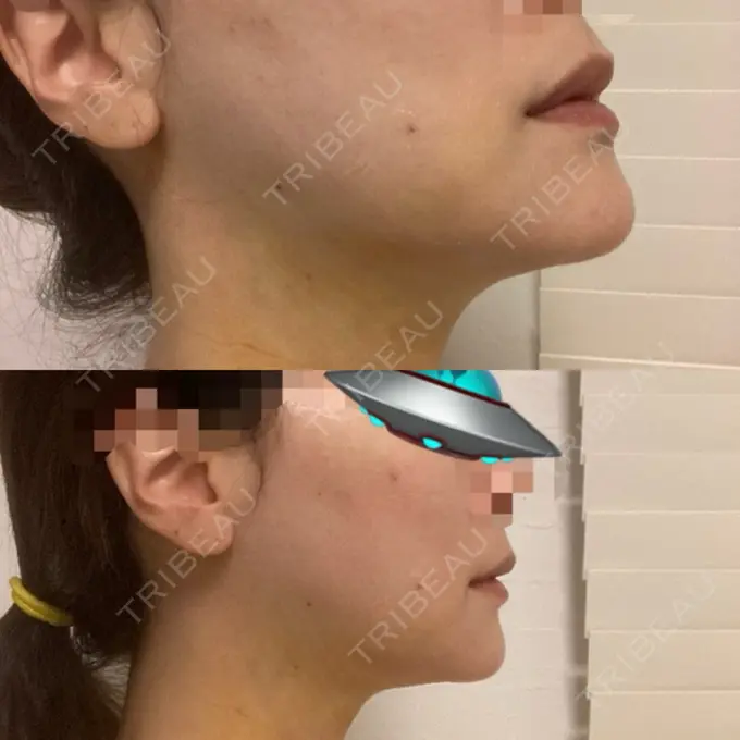 糸リフト / 骨切り（あご） / 脂肪吸引注射（顔） 銀座マイアミ美容外科 DAY 4 メイン用