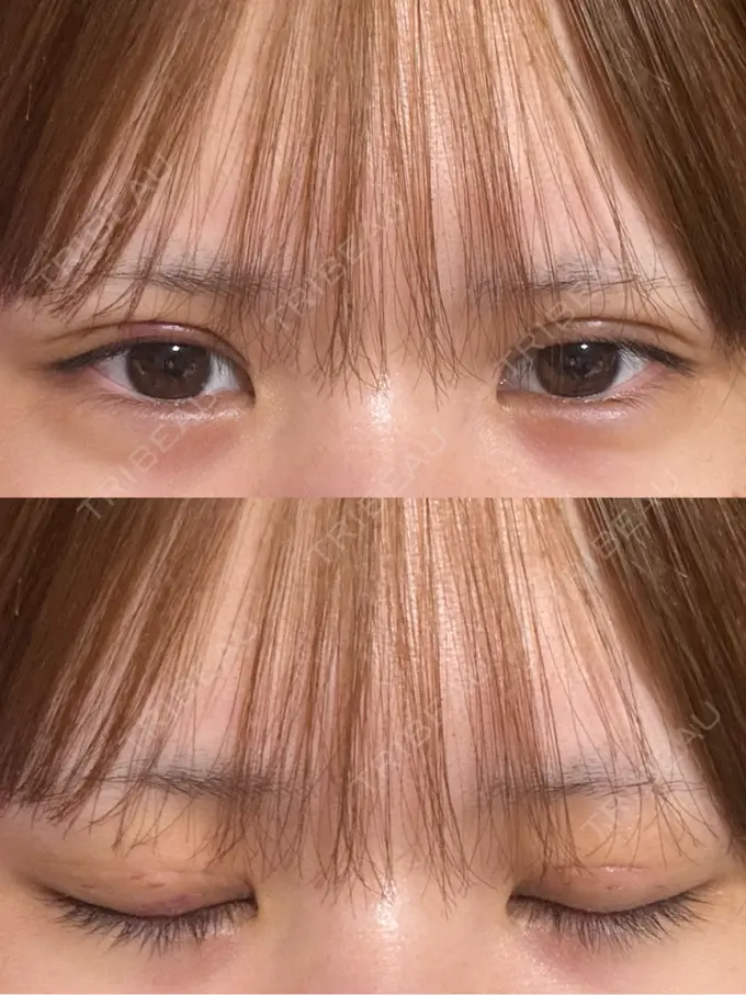 二重埋没 / 上まぶたの脂肪取り THE FIRST CLINIC 多摩センター院 DAY 3 メイン用