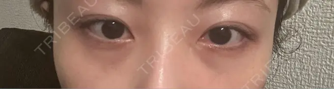 クマ治療 ROOTS Clinic AFTER メイン用