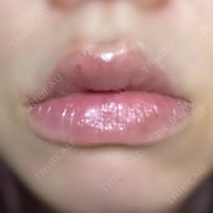 ヒアルロン酸注入（唇） ルラ美容クリニック 名古屋栄院 / ルラスキンクリニック 名古屋栄院 DAY 7 メイン用