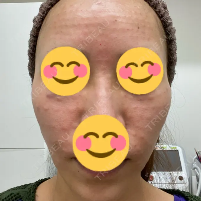 その他（肌） 東京中央クリニック AFTER メイン用