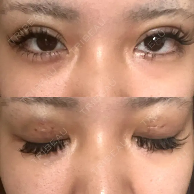 二重埋没 日本ウェルネス再生クリニック DAY 3 メイン用